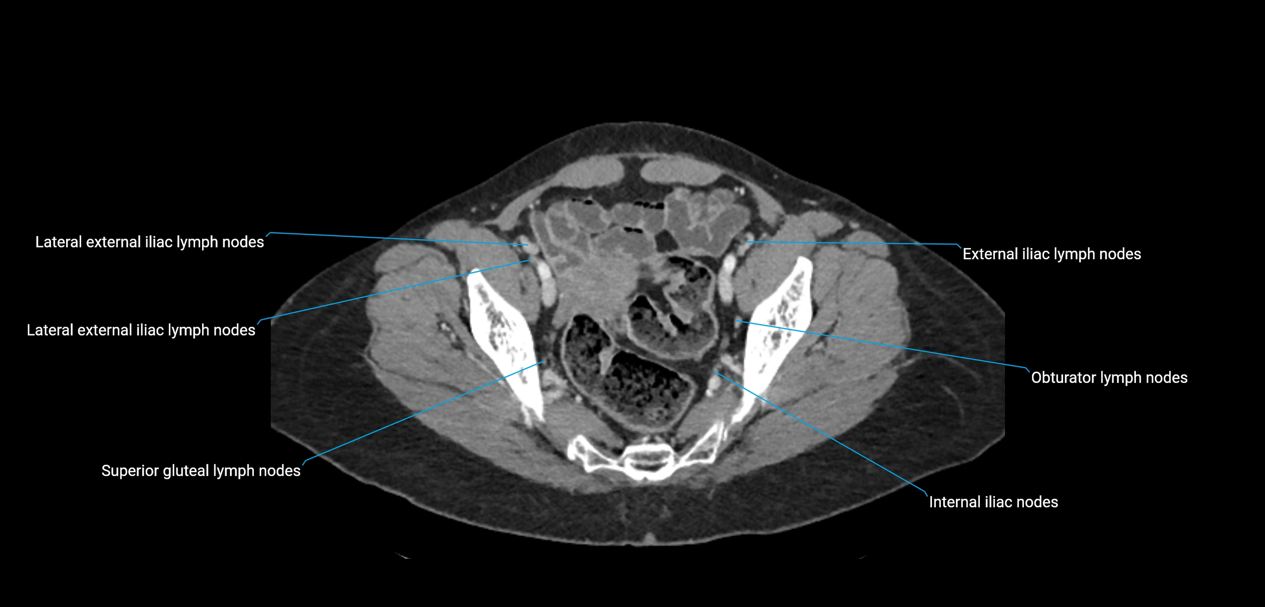 CT ct abdominal lymph nodes  axial cross sectional anatomy  enchanced radiology image -img-00002-00357.webp